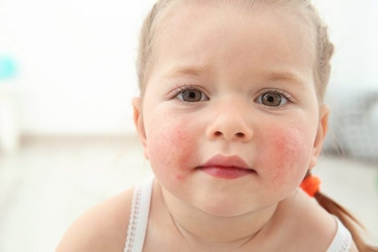 Food Allergies In Babies Causes Symptoms And Treatment Loving Parents